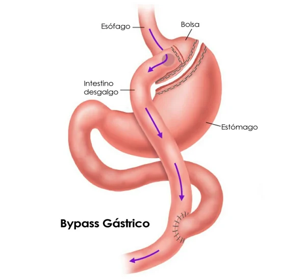 bypass gastrico vida sana con shigo