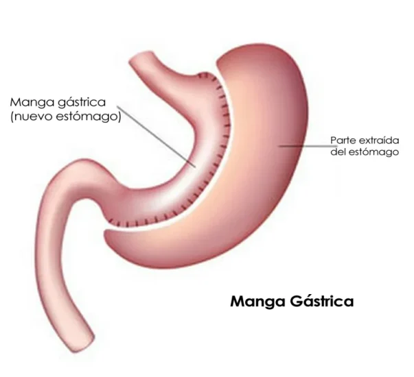 manga-gastrica-vida-sana-con-shigo